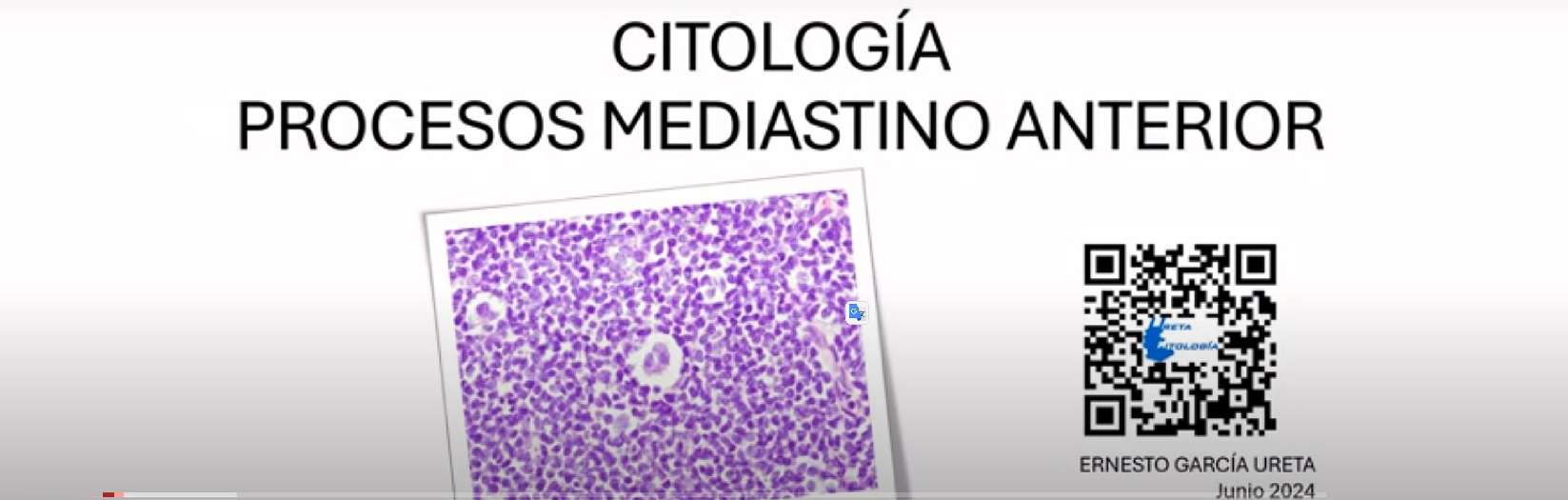 Citología de “Mediastino anterior”